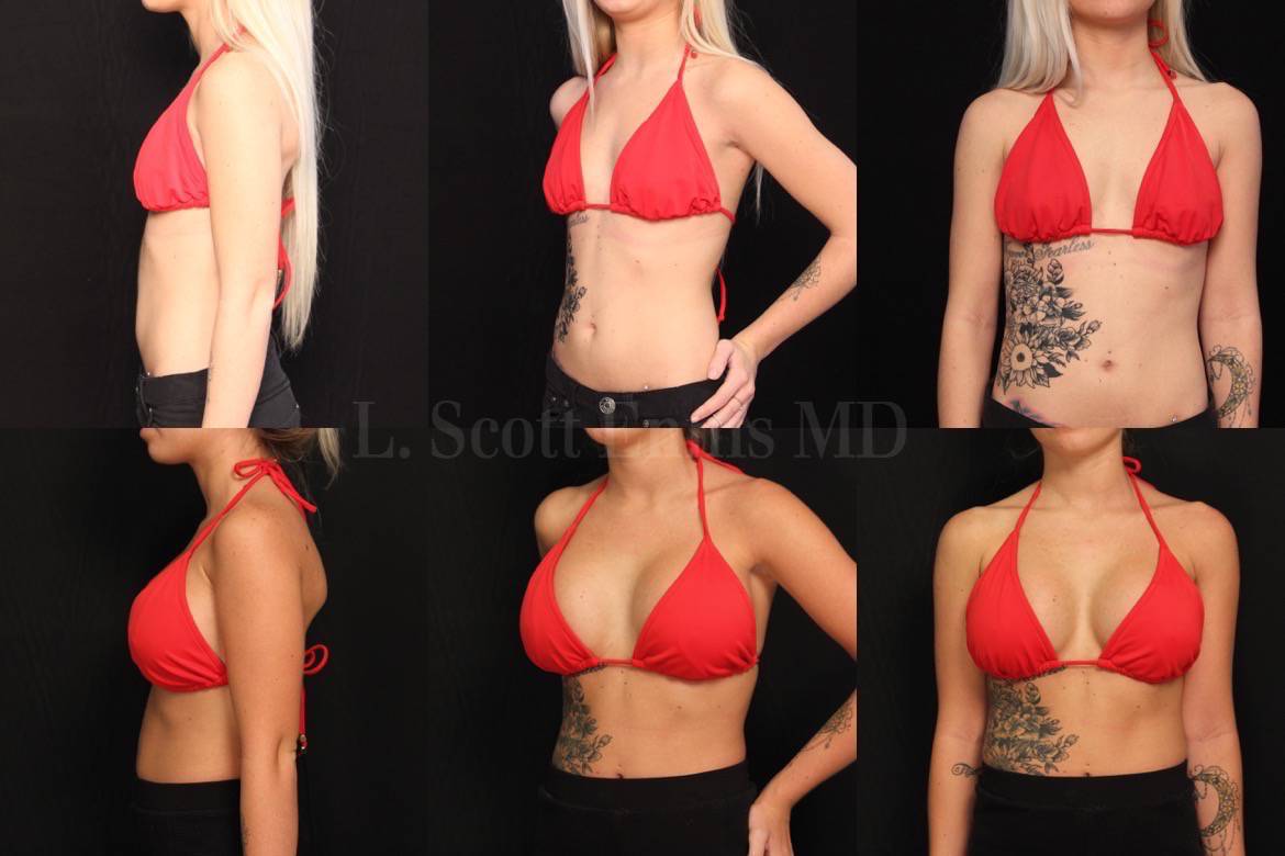 L-Scott-Ennis-MD-22yo 4'10'' 80lb 32A Breast Augmentation Sientra ModPlus Gel R355, L355 (20150105144257924) 20150617155149297