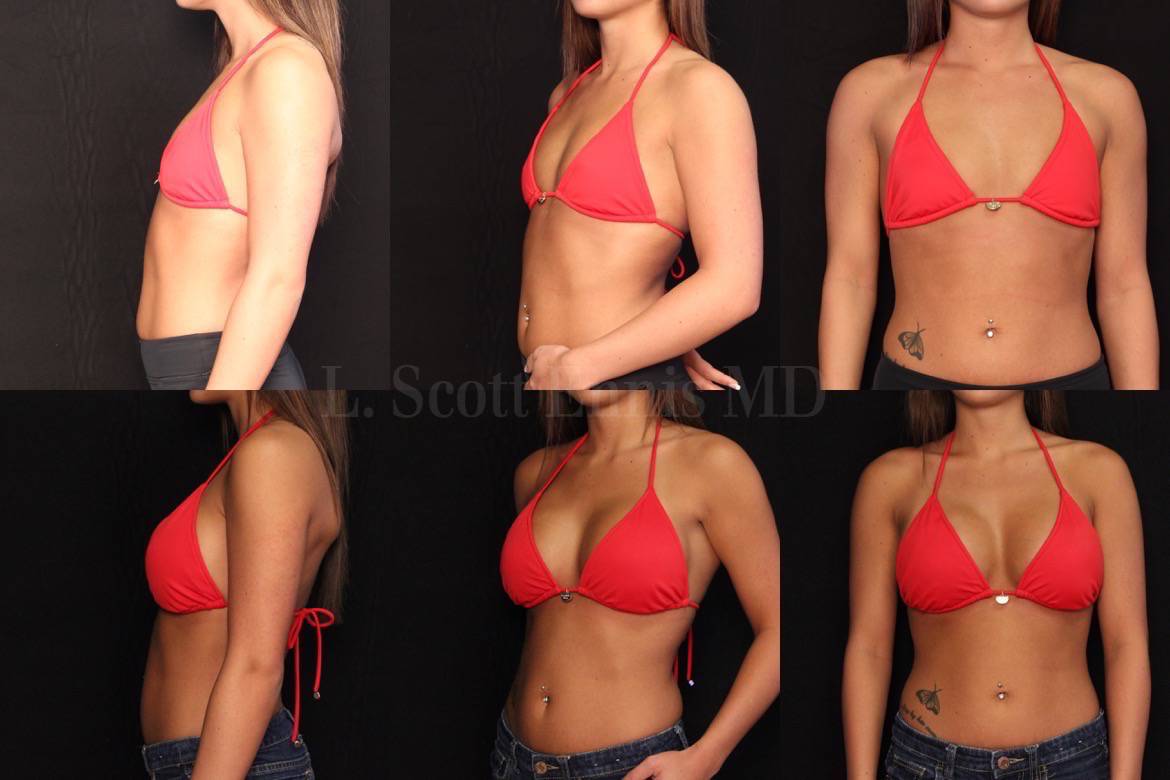 L-Scott-Ennis-MD-22yo  5'4'' 130lbs 34A Bilateral Breast Augmentation with Sientra ModPlus Gel R485 L485 38204