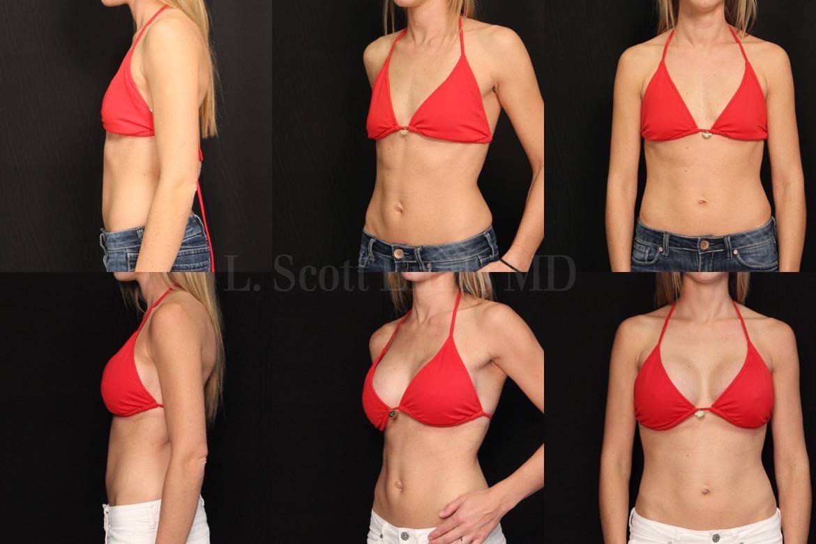 L-Scott-Ennis-MD-29yo  5'4'' 115lbs 34A Bil Breast Augmentation Sientra ModPlus Gel R440 L410 37978