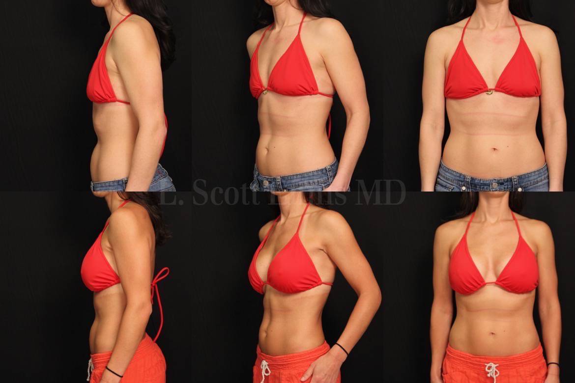 Lovin' this 34B to 34D transformation 🔥 Breast Augmentation and