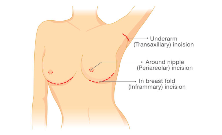breast augmentation incision types