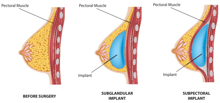 breast implant placement