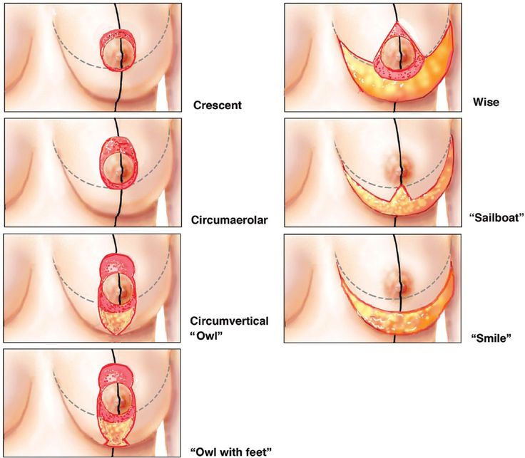 breast lift incision types illustration