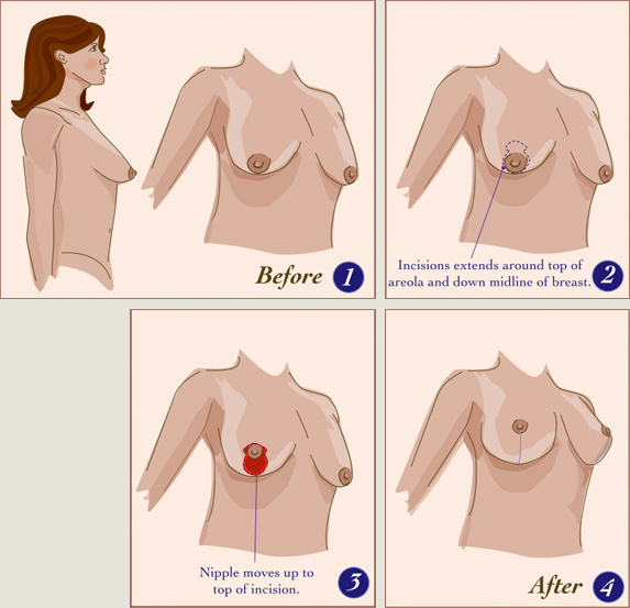 breast lift process illustration