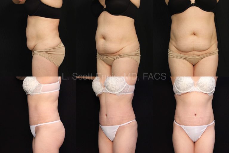 drainless tummy tuck patient by dr ennis