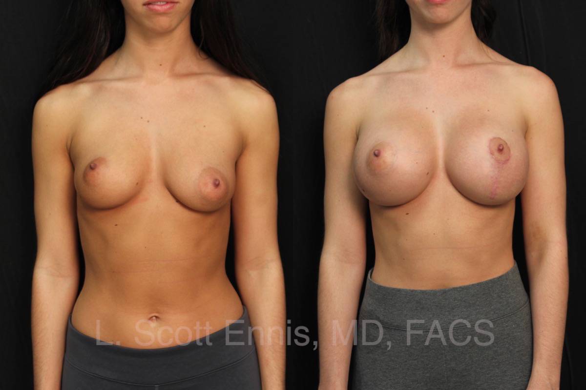 Breast enlarge surgery - Nude pics