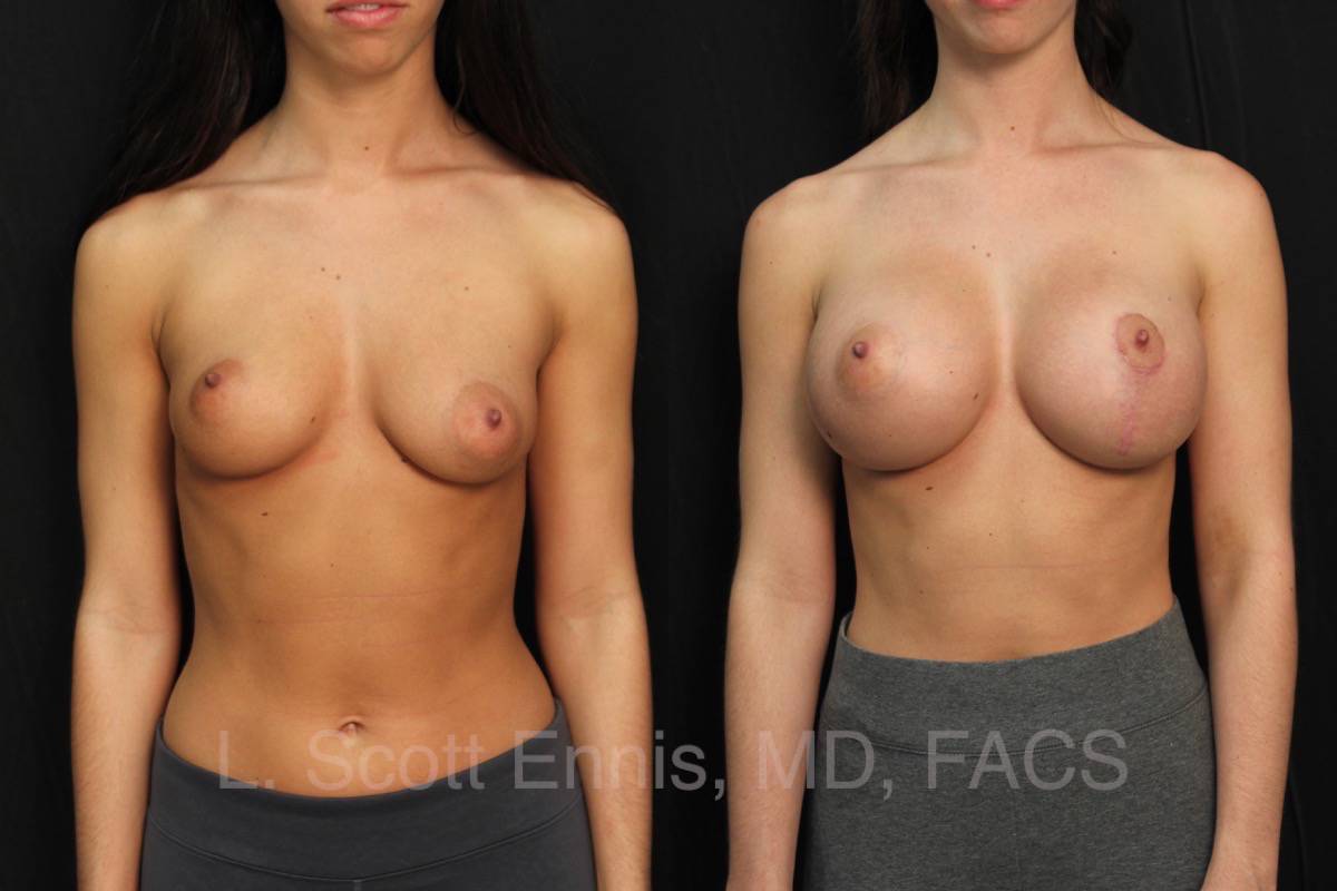 34d breast nude