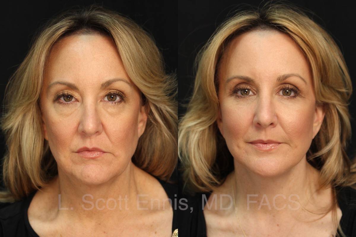 Facelift Before & After