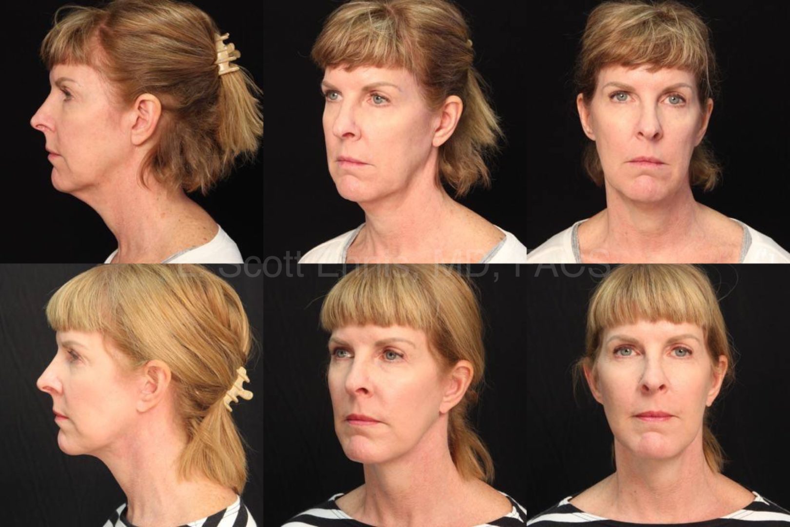 Ennis MD Before and After 55yof Facelift Exc of Buccal fat pads (20150817073730276) 20160712141911754 39602