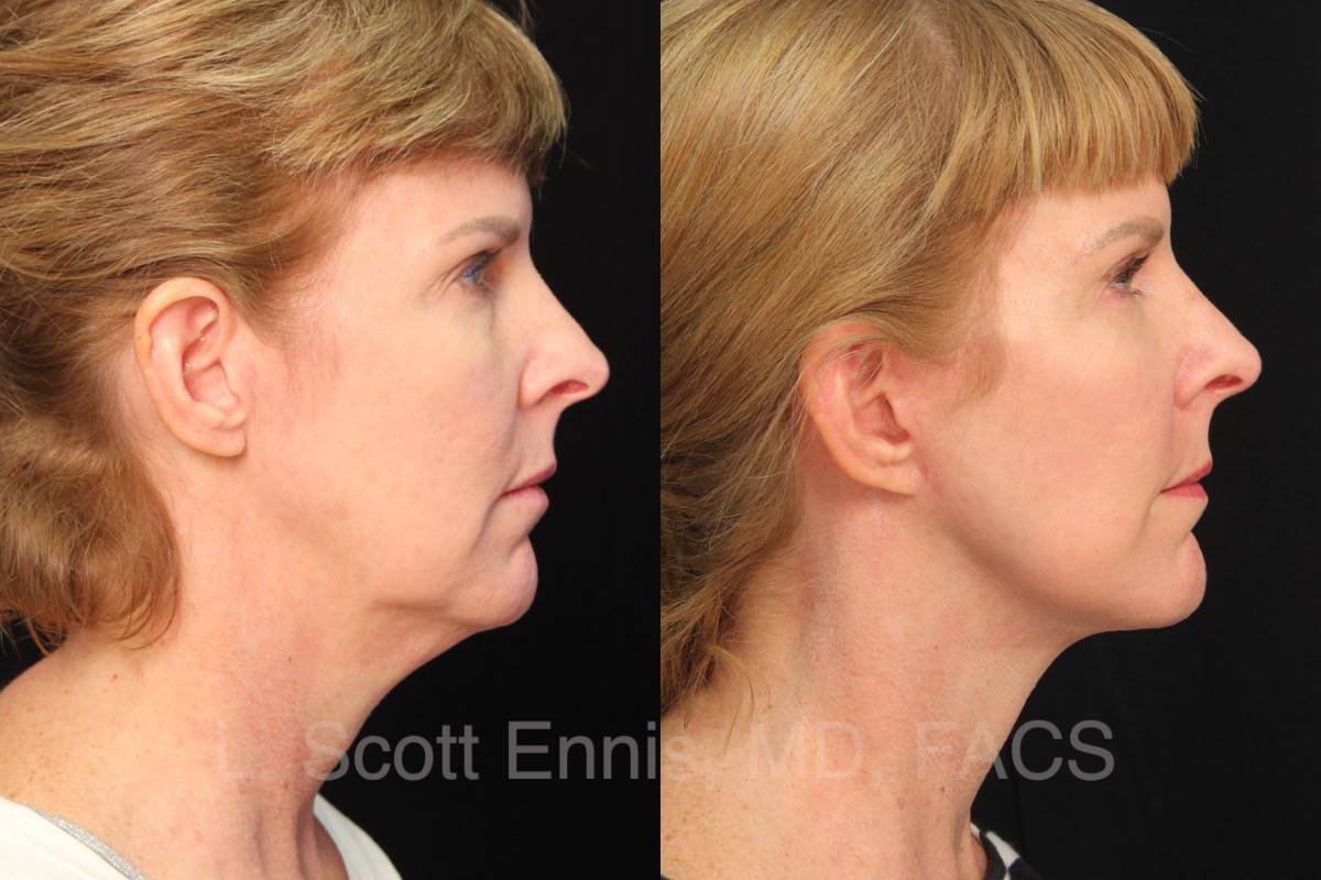 Ennis MD Before and After 55yof Facelift Exc of Buccal fat pads (20150817073730276) 20170828163645734 39602