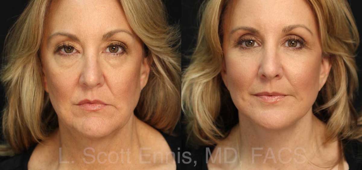 Facelift Misconceptions & Deep Plane Facelift for Natural Look