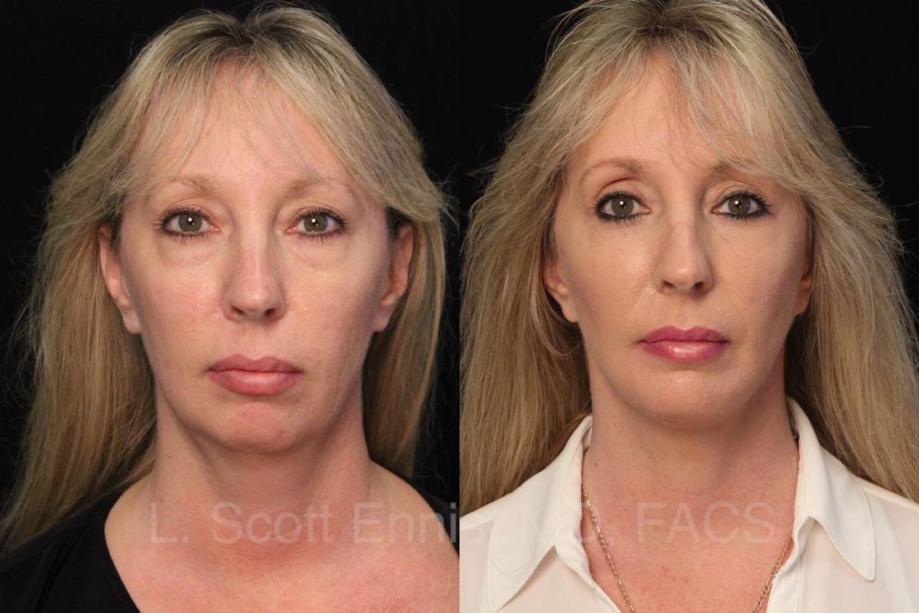 Facelift Before & After