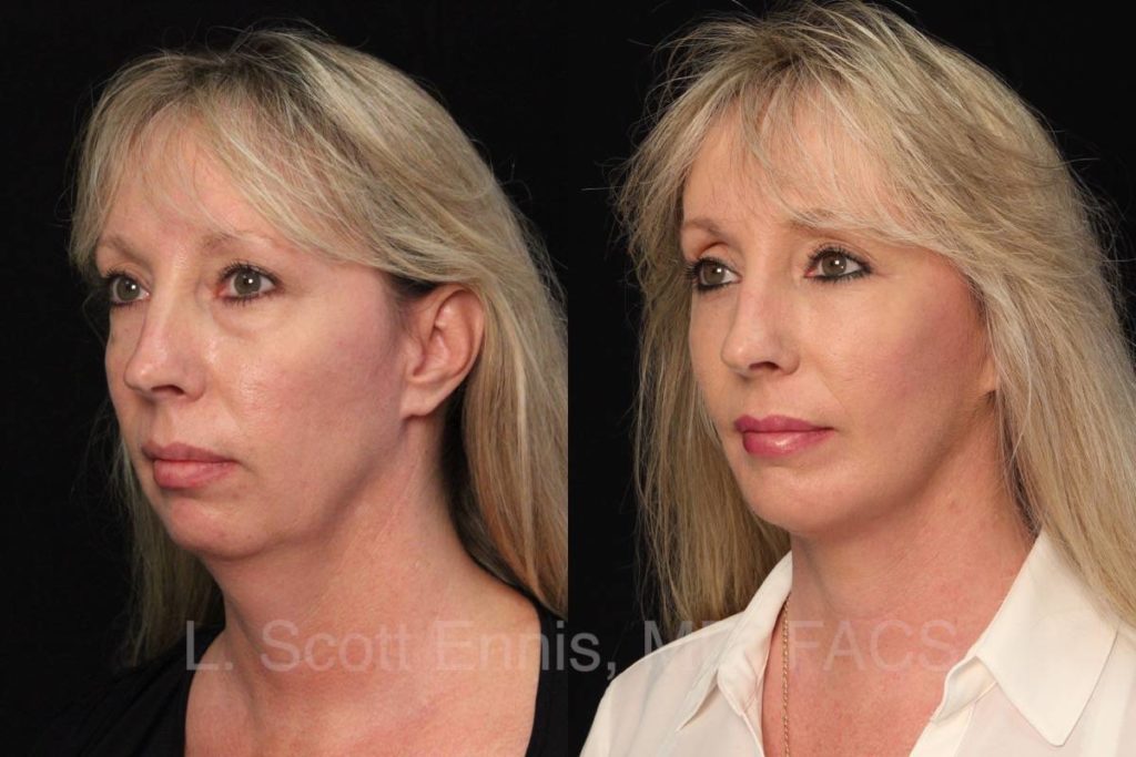 Facelift Before & After