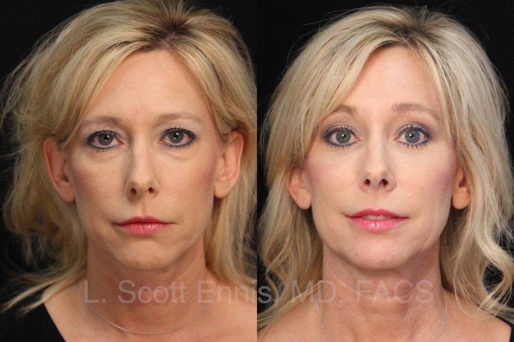 Facelift Before & After