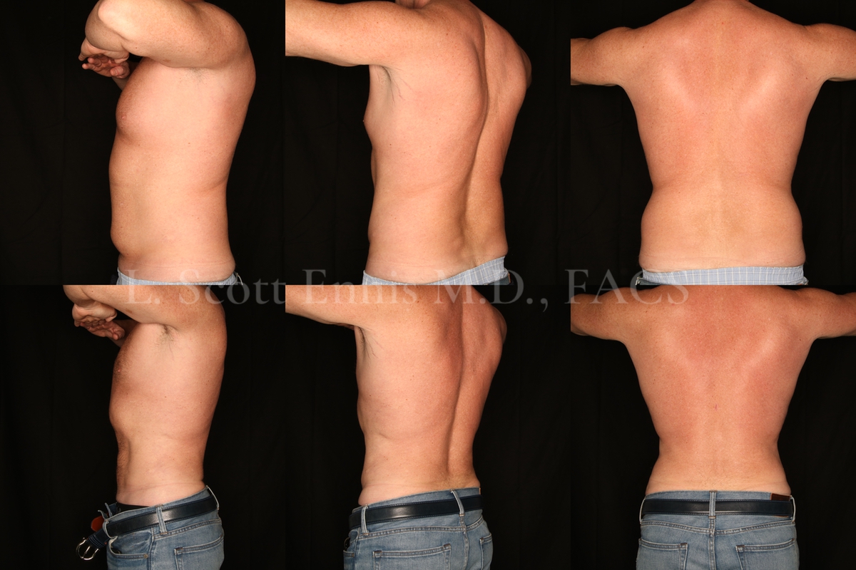 Liposuction for Men Before and After at Ennis Plastic Surgery 45YOM liposuction of the Abdomen and hips-back Destin Palm Beach Boca Raton 50134 (3)