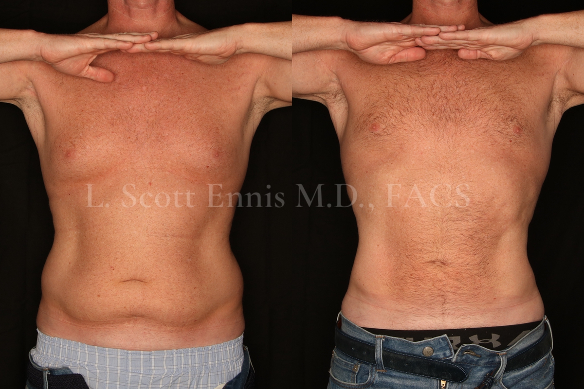 Liposuction for Men Before and After at Ennis Plastic Surgery 45YOM liposuction of the Abdomen and hips-back Destin Palm Beach Boca Raton 50134 (4)