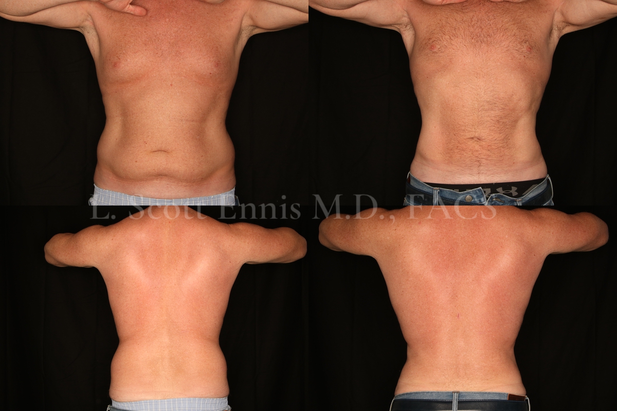 Liposuction for Men Before and After at Ennis Plastic Surgery 45YOM liposuction of the Abdomen and hips-back Destin Palm Beach Boca Raton 50134 (5)