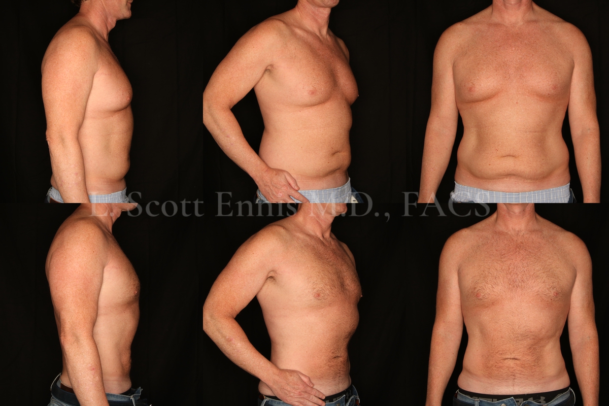 Liposuction for Men Before and After at Ennis Plastic Surgery 45YOM liposuction of the Abdomen and hips-back Destin Palm Beach Boca Raton 50134